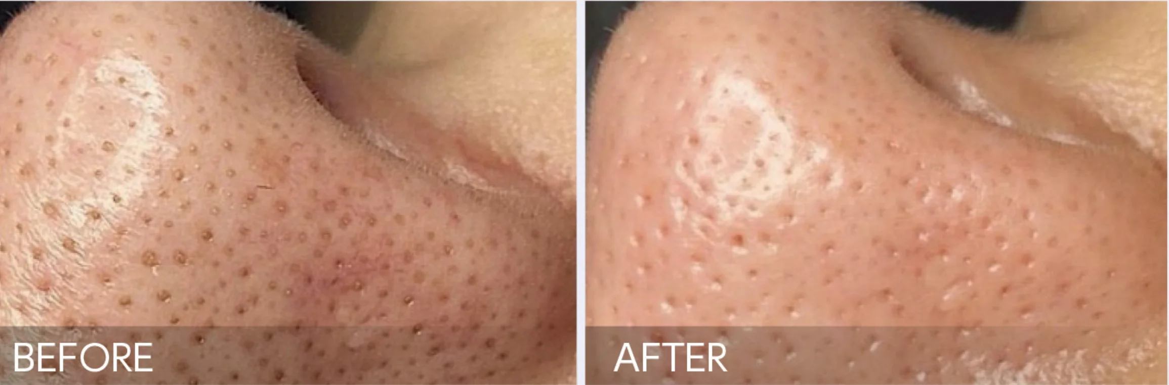 毛穴のつまりが軽減しました。