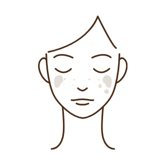 しみ（そばかす・ほくろ）