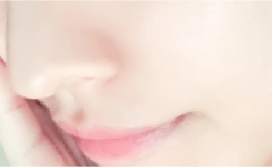 ケミカルピーリング