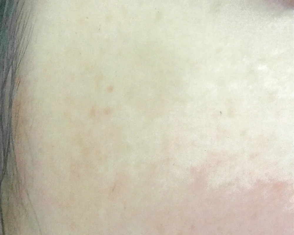 しみ取りレーザーAFTER