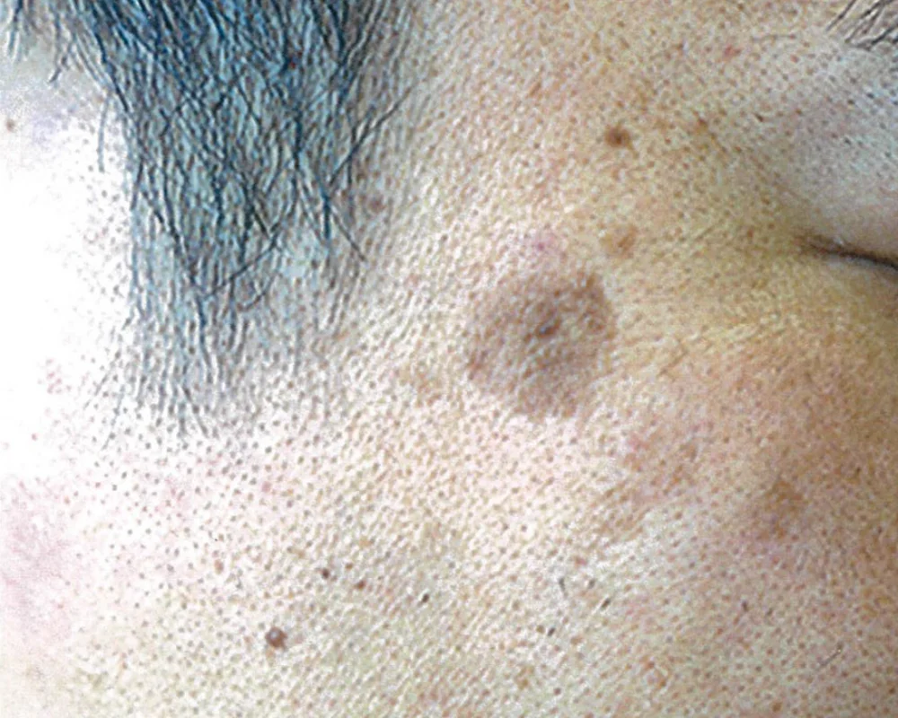 しみ取りレーザーBEFORE