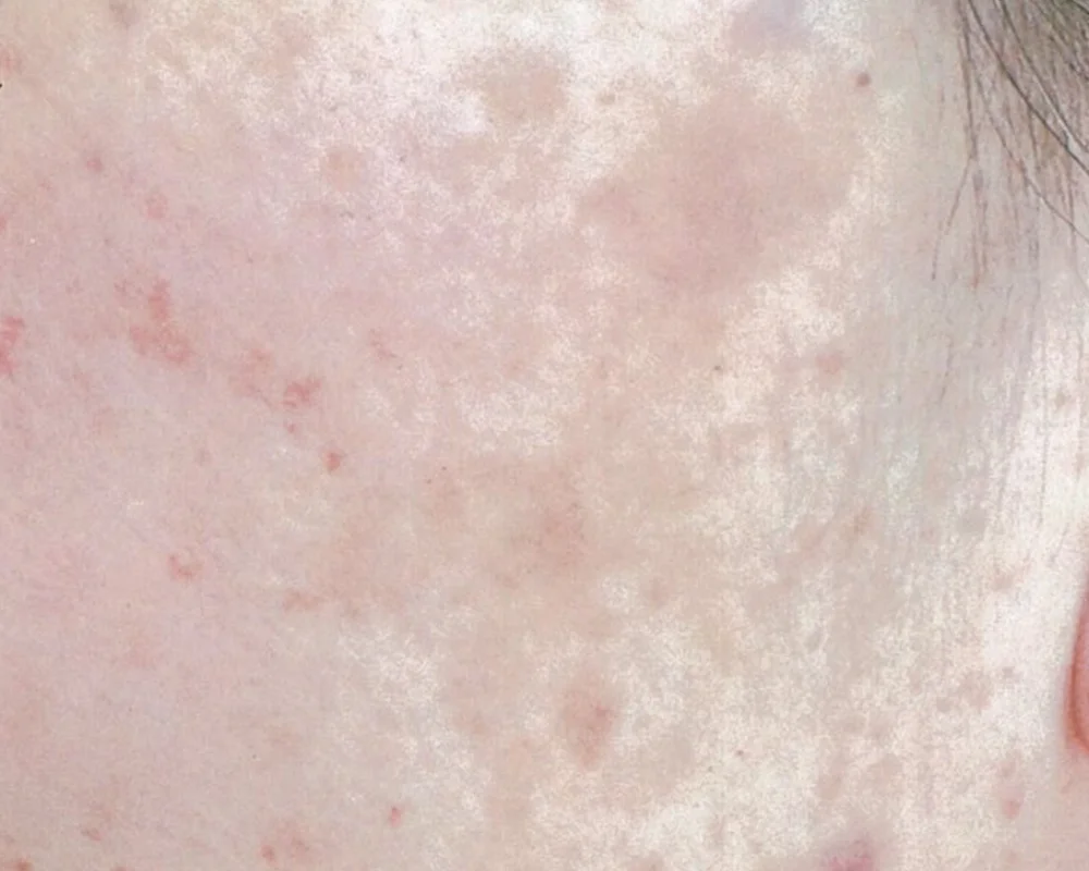 しみ取りレーザー治療+イオン導入(TA)AFTER