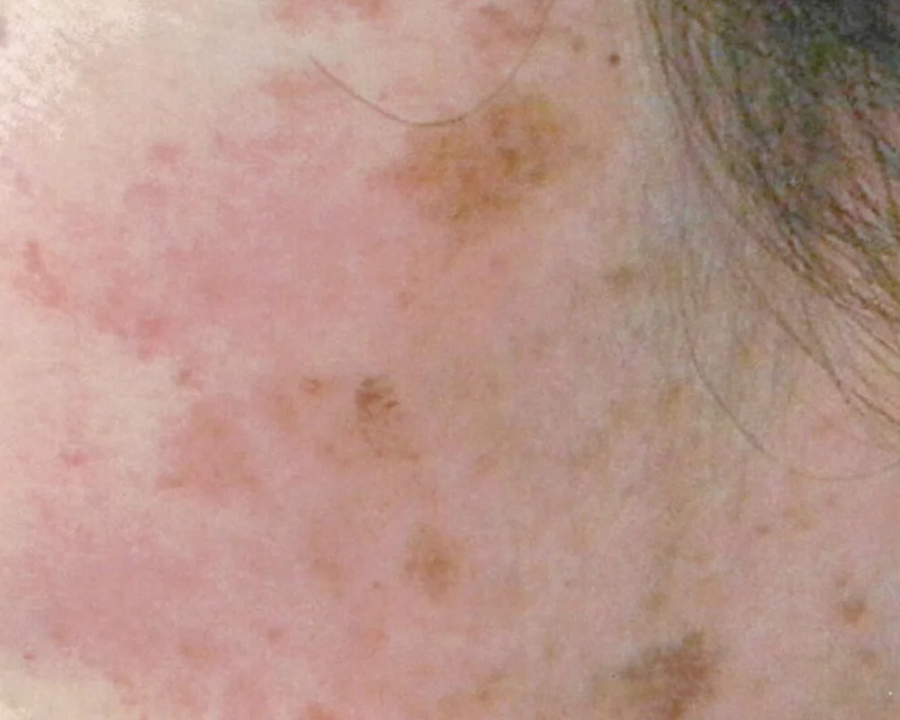 しみ取りレーザー治療+イオン導入(TA)BEFORE